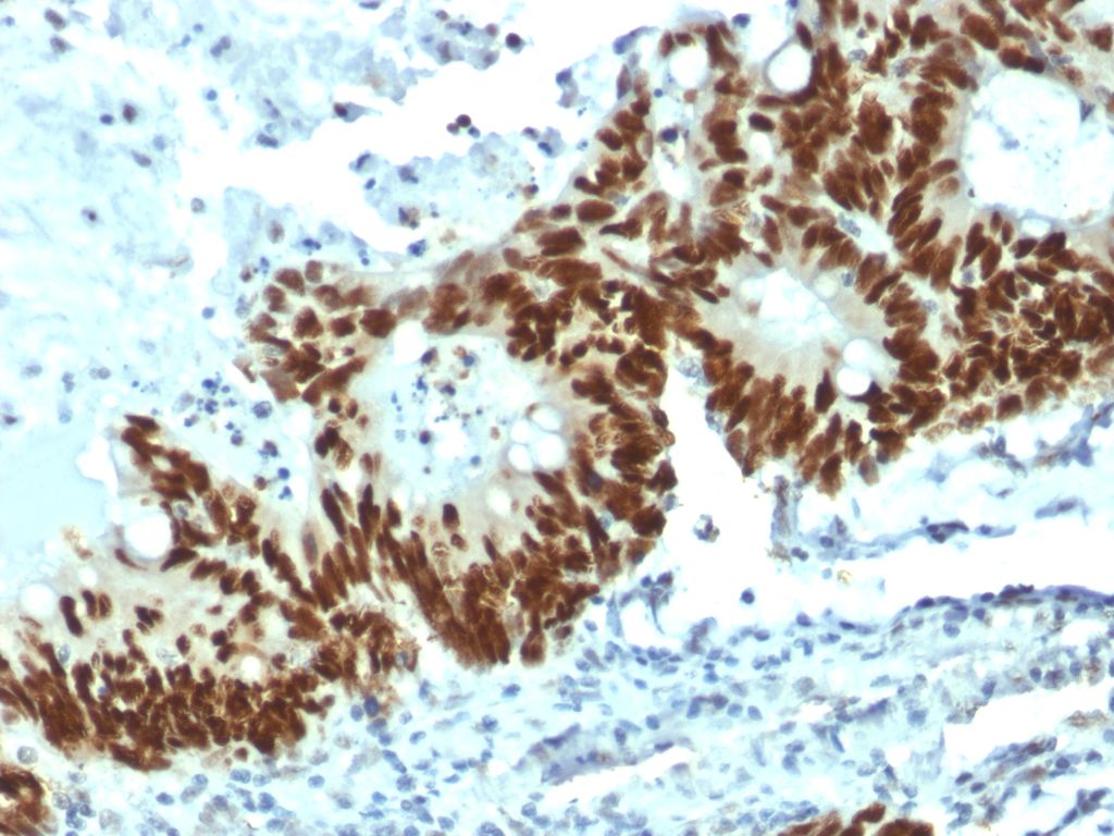 Figure 1: Strong nuclear staining of p53 with MUB1501P (DO-1) in a formalin-fixed, paraffin-embedded human colon carcinoma.